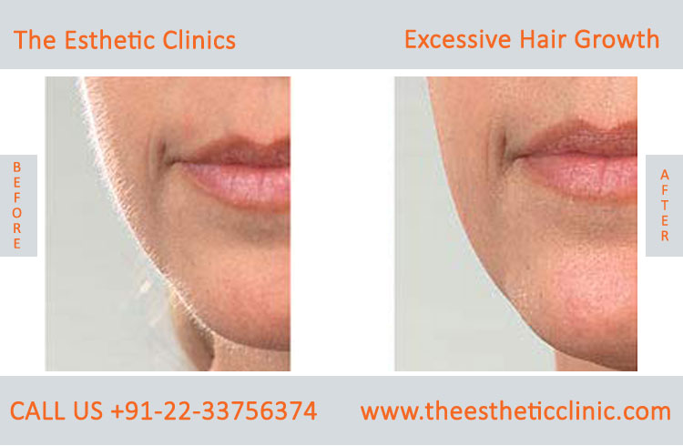 Excessive Hair Growth Removal Treatment before after photos in mumbai india (4)